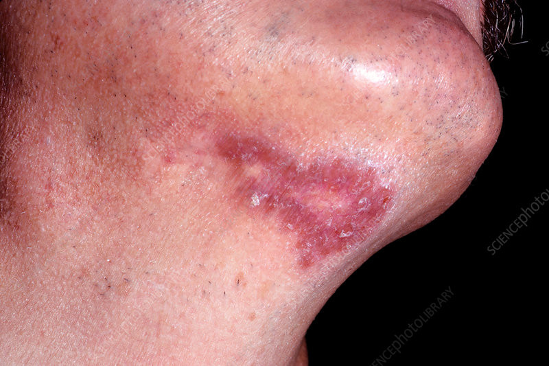 Tuberkulosis (TB) Kutis